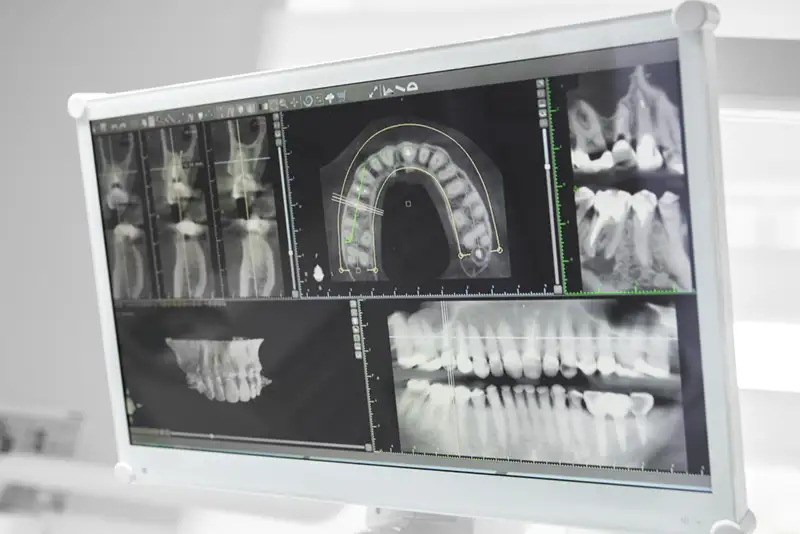 Tandimplantat Alby – röntgenbild