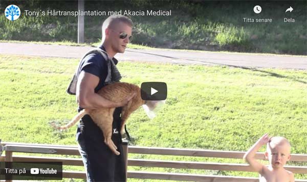 Hårttransplantation video