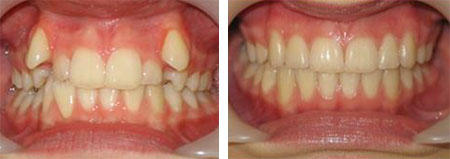 före & efter invisalign